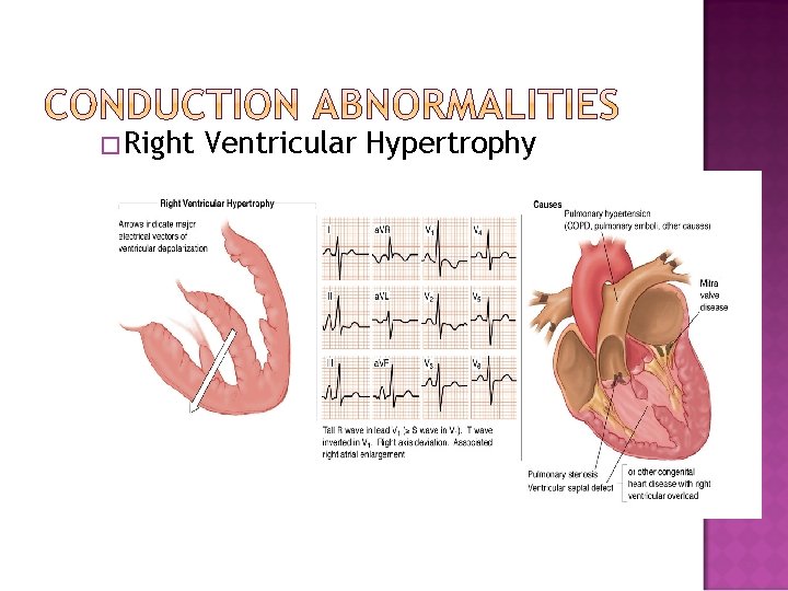 �Right Ventricular Hypertrophy 
