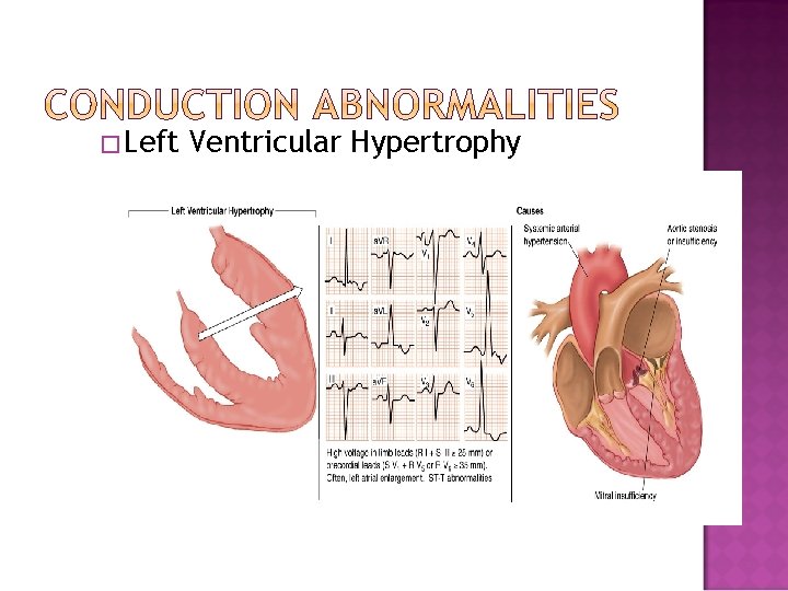 �Left Ventricular Hypertrophy 