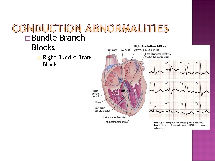 �Bundle Branch Blocks Right Bundle Branch Block 