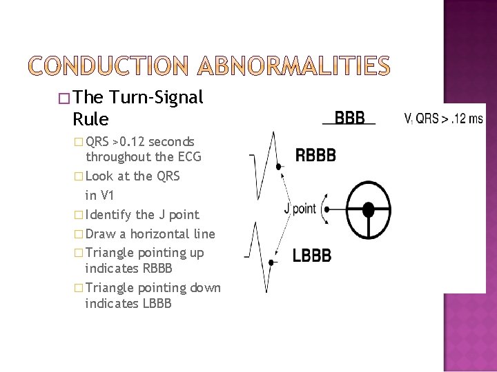 � The Turn-Signal Rule � QRS >0. 12 seconds throughout the ECG � Look