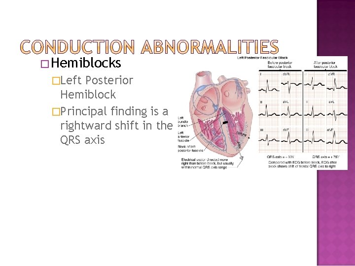 �Hemiblocks �Left Posterior Hemiblock �Principal finding is a rightward shift in the QRS axis