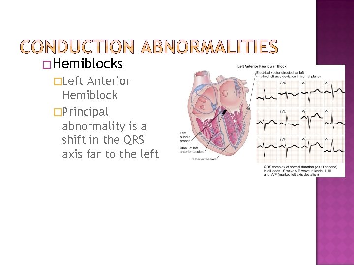 �Hemiblocks �Left Anterior Hemiblock �Principal abnormality is a shift in the QRS axis far