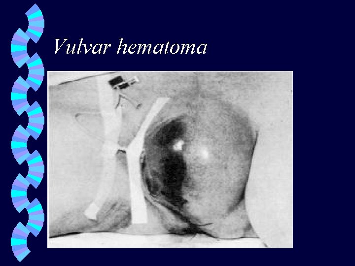 Vulvar hematoma 