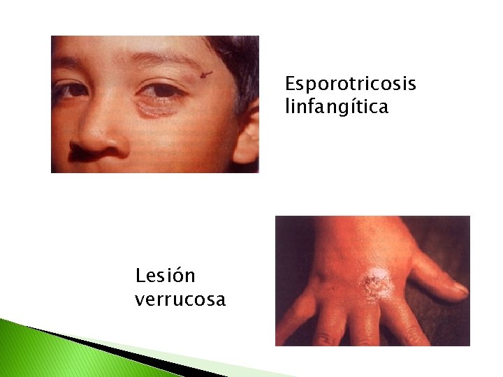 Esporotricosis linfangítica Lesión verrucosa 