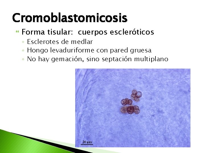 Cromoblastomicosis Forma tisular: cuerpos escleróticos ◦ Esclerotes de medlar ◦ Hongo levaduriforme con pared