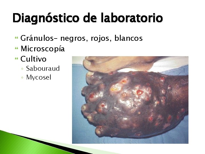 Diagnóstico de laboratorio Gránulos– negros, rojos, blancos Microscopía Cultivo ◦ Sabouraud ◦ Mycosel 