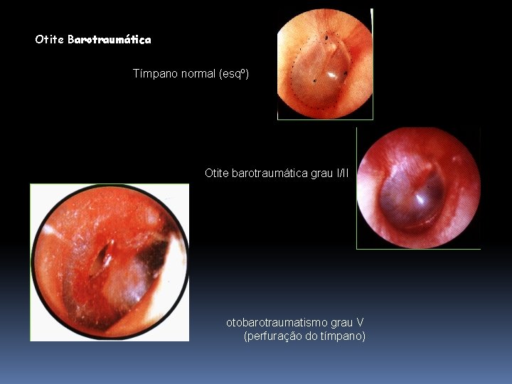 Otite Barotraumática Tímpano normal (esqº) Otite barotraumática grau I/II otobarotraumatismo grau V (perfuração do