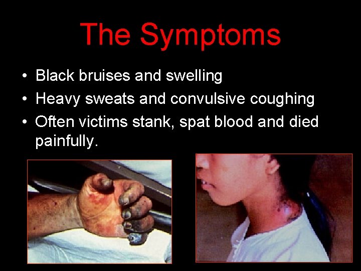 The Symptoms • Black bruises and swelling • Heavy sweats and convulsive coughing •