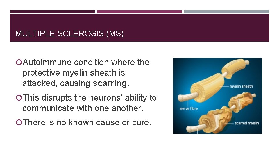MULTIPLE SCLEROSIS (MS) Autoimmune condition where the protective myelin sheath is attacked, causing scarring.