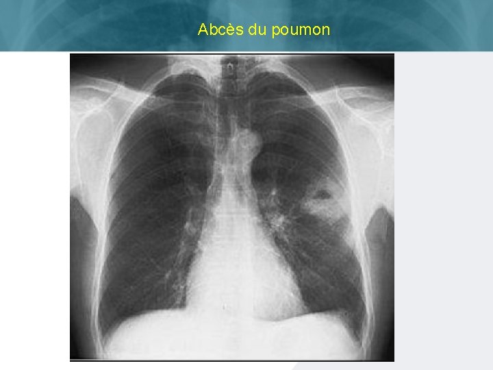 Abcès du poumon ISTC TB Training Modules 2009 