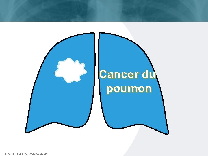 Cancer du poumon ISTC TB Training Modules 2009 
