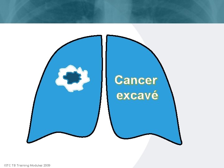 Cancer excavé ISTC TB Training Modules 2009 