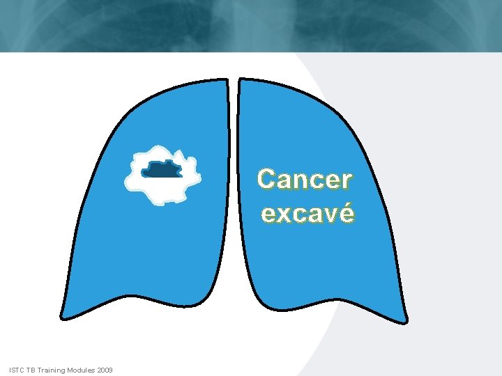 Cancer excavé ISTC TB Training Modules 2009 