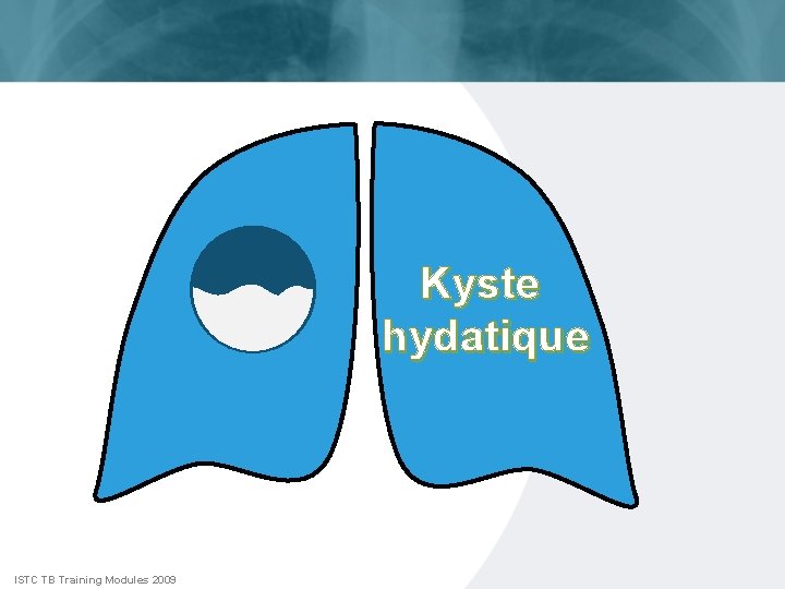 Kyste hydatique ISTC TB Training Modules 2009 