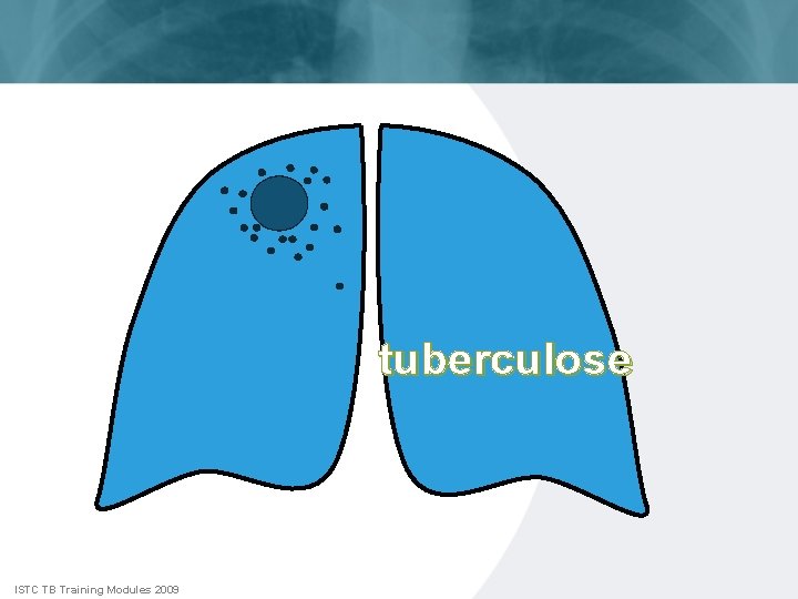 tuberculose ISTC TB Training Modules 2009 