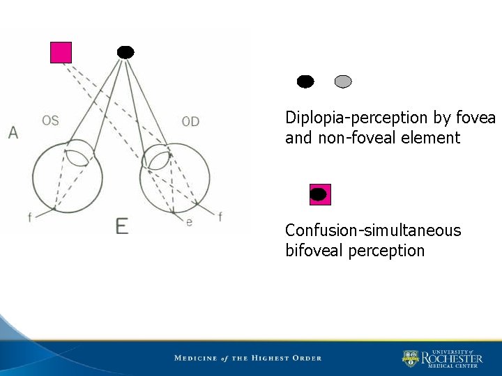 Diplopia-perception by fovea and non-foveal element Confusion-simultaneous bifoveal perception 