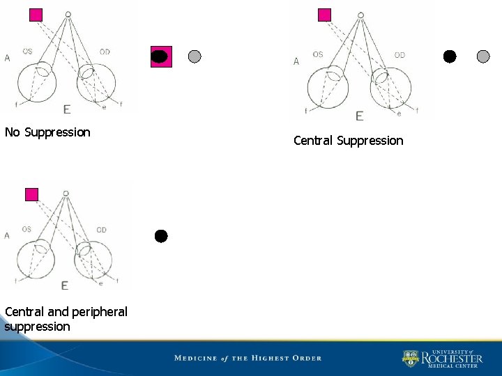 No Suppression Central and peripheral suppression Central Suppression 