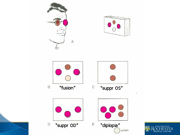 “fusion” “suppr OD” “suppr OS” “diplopia” 