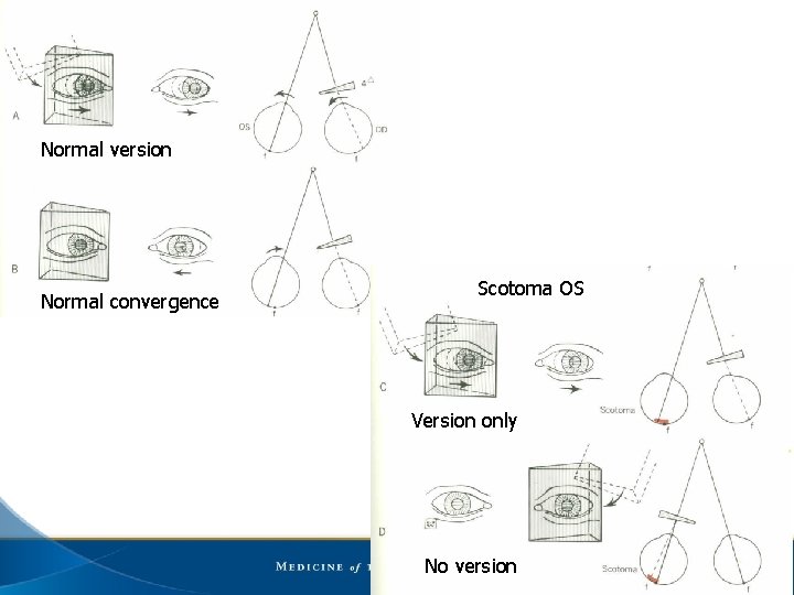 Normal version Normal convergence Scotoma OS Version only No version 