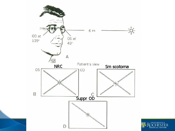 NRC Sm scotoma Suppr OD 