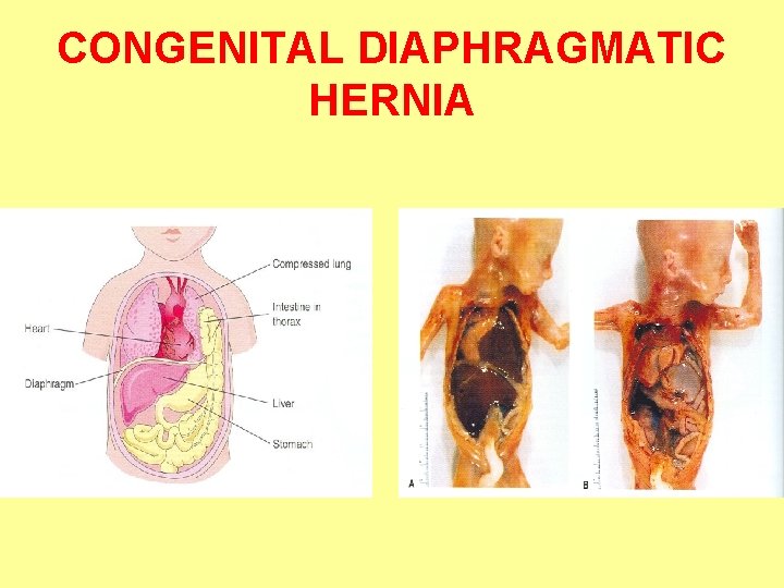 CONGENITAL DIAPHRAGMATIC HERNIA 