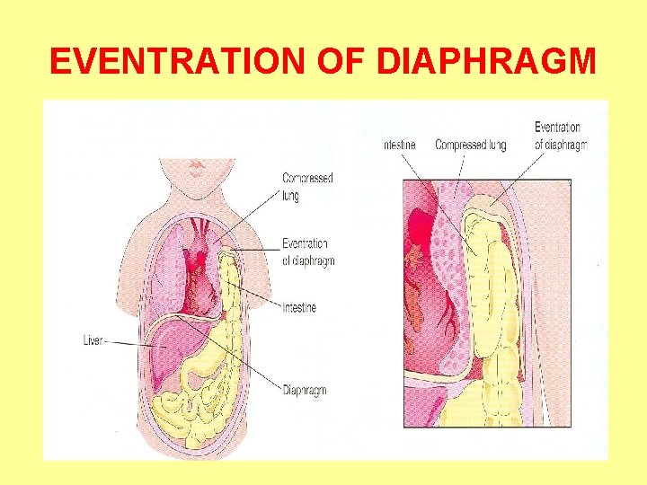 EVENTRATION OF DIAPHRAGM 