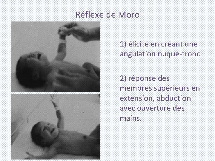 Réflexe de Moro 1) élicité en créant une angulation nuque-tronc 2) réponse des membres