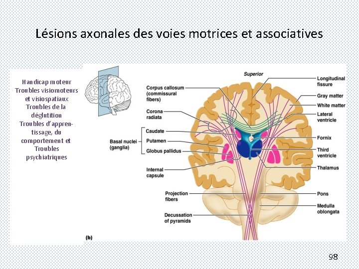 Lésions axonales des voies motrices et associatives Handicap moteur Troubles visiomoteurs et visiospatiaux Troubles
