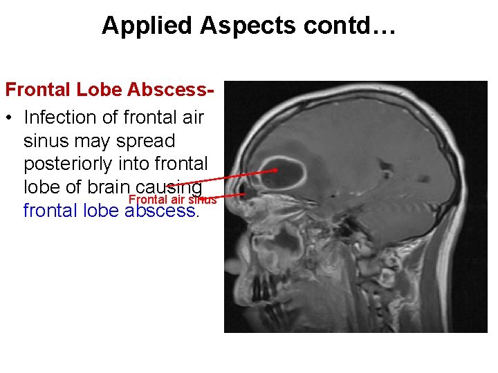 Applied Aspects contd… Frontal Lobe Abscess • Infection of frontal air sinus may spread