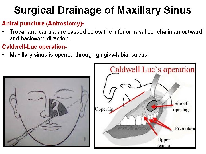 Surgical Drainage of Maxillary Sinus Antral puncture (Antrostomy) • Trocar and canula are passed