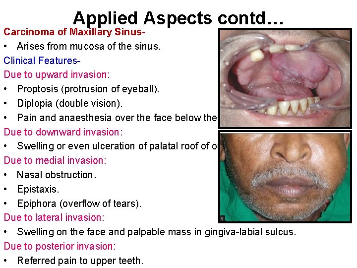 Applied Aspects contd… Carcinoma of Maxillary Sinus • Arises from mucosa of the sinus.