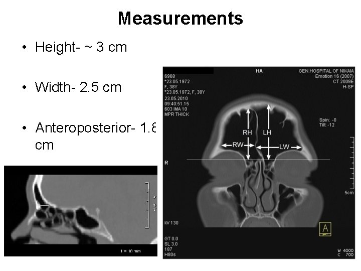 Measurements • Height- ~ 3 cm • Width- 2. 5 cm • Anteroposterior- 1.