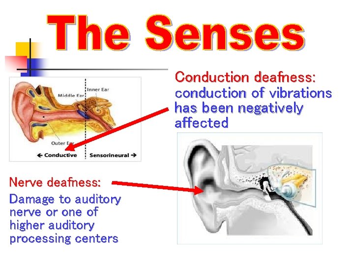 Conduction deafness: Conduction conduction of vibrations has been negatively affected Nerve deafness: Damage to