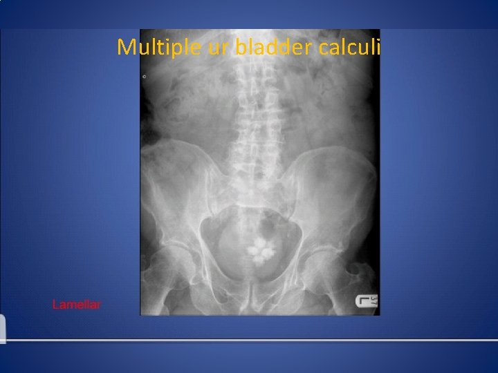 Multiple ur bladder calculi 