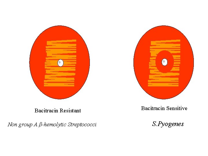 B Bacitracin Resistant Non group A β-hemolytic Streptococci B Bacitracin Sensitive S. Pyogenes 