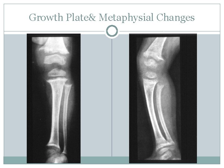 Growth Plate& Metaphysial Changes 