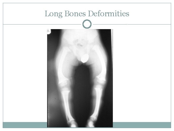 Long Bones Deformities 