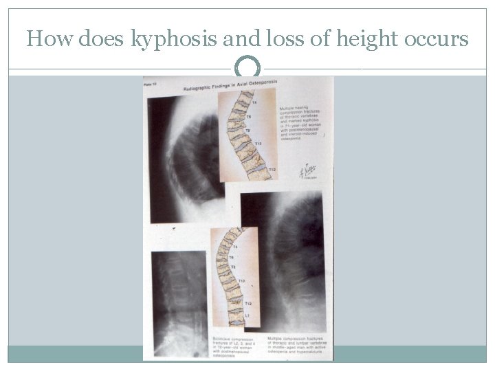 How does kyphosis and loss of height occurs 