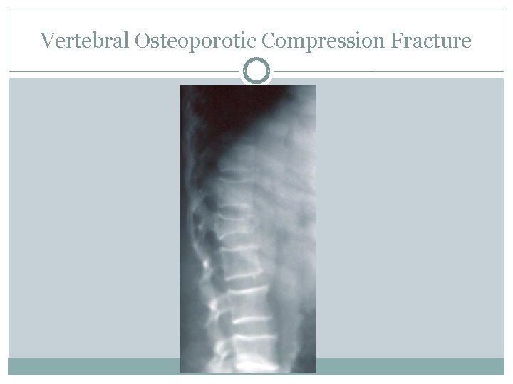 Vertebral Osteoporotic Compression Fracture 