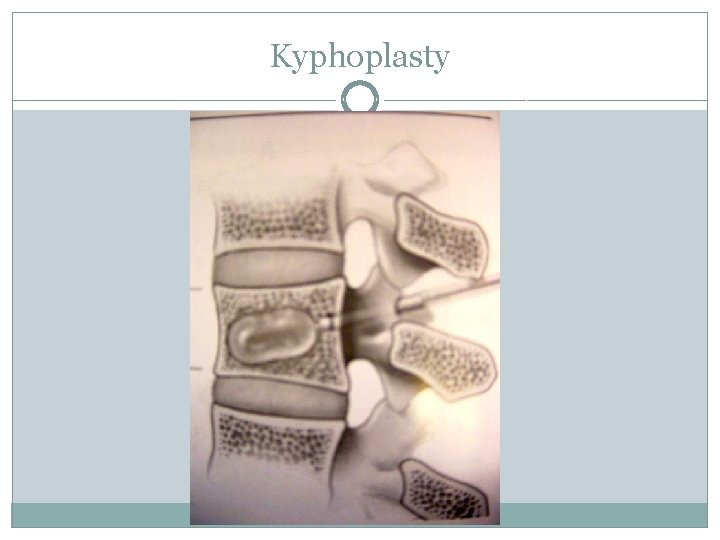 Kyphoplasty 