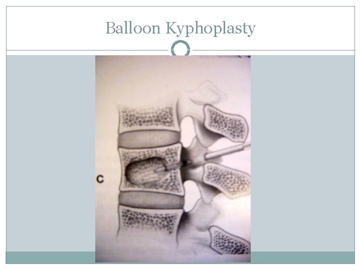 Balloon Kyphoplasty 