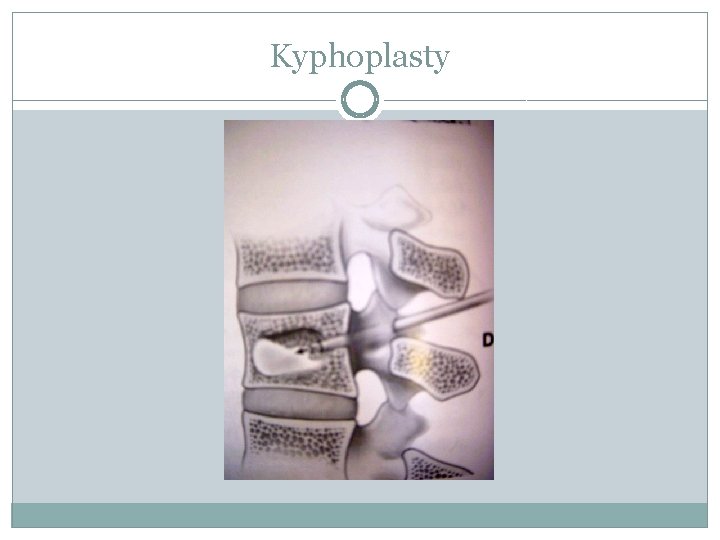 Kyphoplasty 