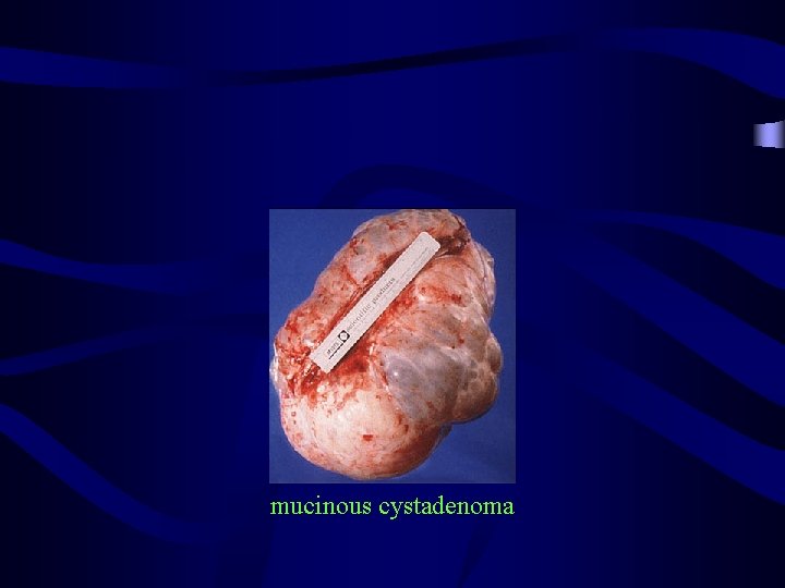 mucinous cystadenoma 