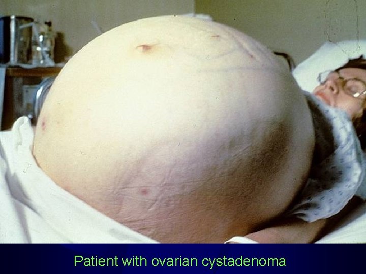 Patient with ovarian cystadenoma 