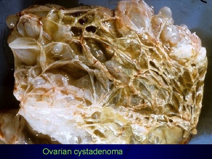 Ovarian cystadenoma 