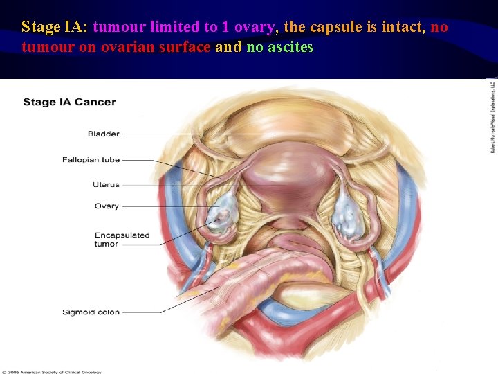 Stage IA: tumour limited to 1 ovary, the capsule is intact, no tumour on