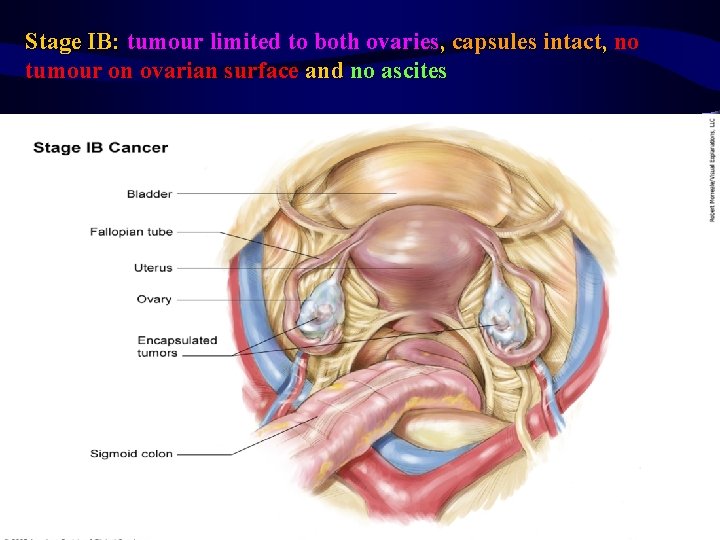 Stage IB: tumour limited to both ovaries, capsules intact, no tumour on ovarian surface
