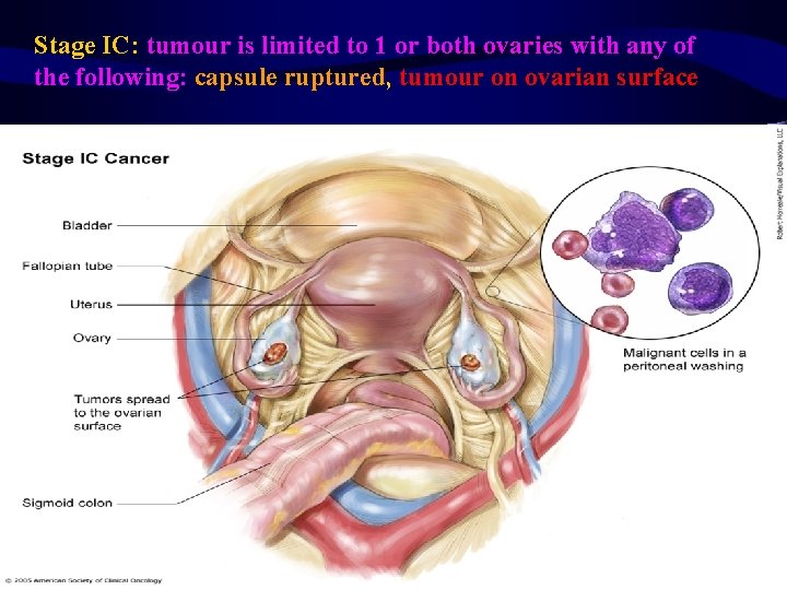 Stage IC: tumour is limited to 1 or both ovaries with any of the