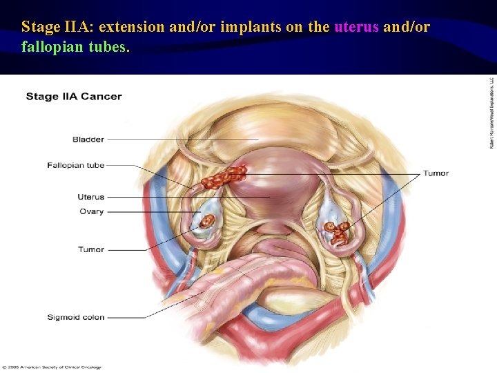 Stage IIA: extension and/or implants on the uterus and/or fallopian tubes. 