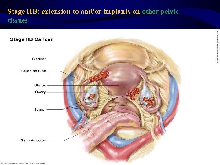 Stage IIB: extension to and/or implants on other pelvic tissues 